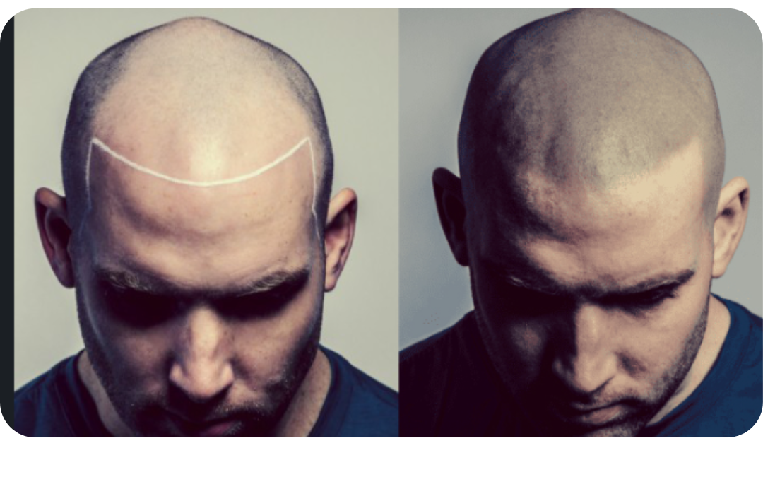 What Is Scalp Micropigmentation (SMP) & How Does It Work?