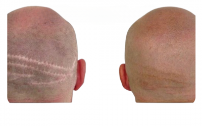 Scalp micropigmentation vs hair transplant comparison showing shaved SMP result and transplant scarring