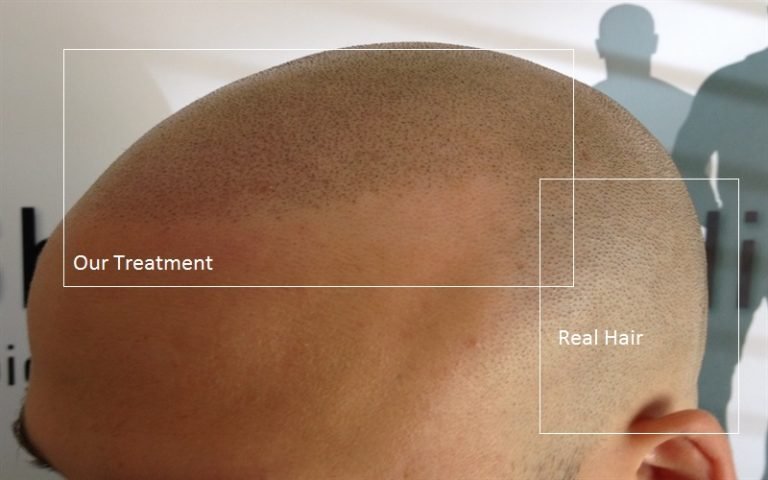 Natural scalp micropigmentation before and after results showing realistic hairline appearance
