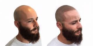Scalp micropigmentation vs hair transplant comparison showing shaved SMP result and transplant scarring