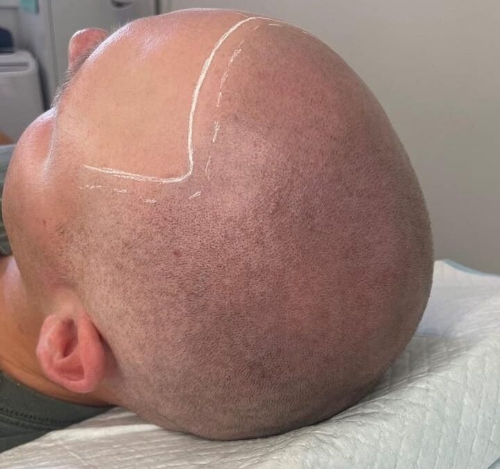 How technicians design hairline placement: expert guide